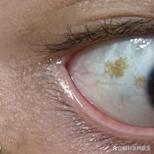 儿童眼睛里的黑斑是先天性的吗？需要警惕哪些眼部疾病？-第3张图片-郑州医学网