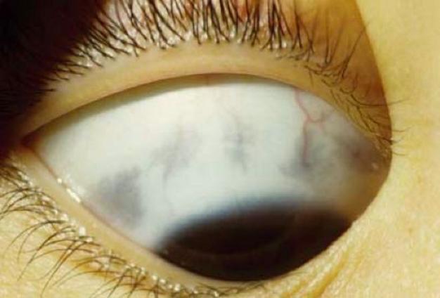 儿童眼睛里的黑斑是先天性的吗？需要警惕哪些眼部疾病？-第2张图片-郑州医学网