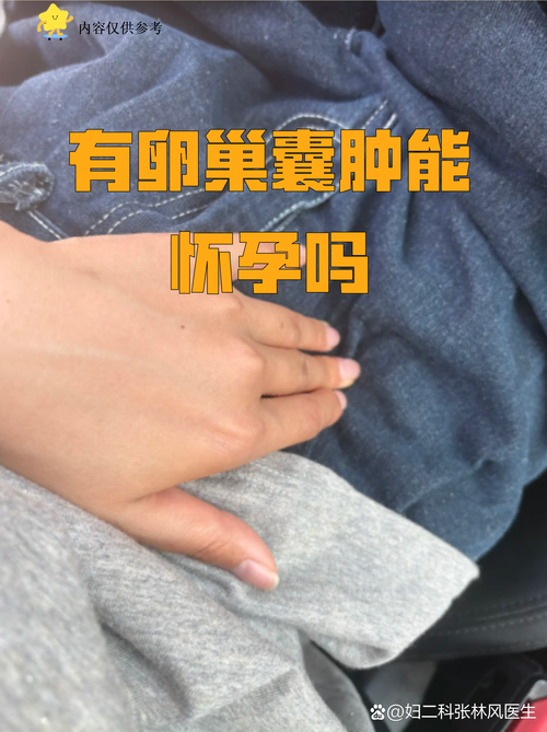 孕期发现卵巢囊肿应该挂什么科？需要立即手术吗？对胎儿有影响吗？-第2张图片-郑州医学网