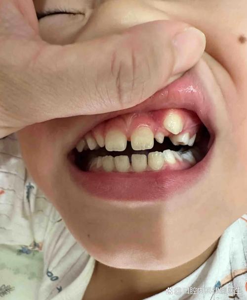 儿童牙龈上长牙齿是正常现象吗？需要处理吗？-第1张图片-郑州医学网