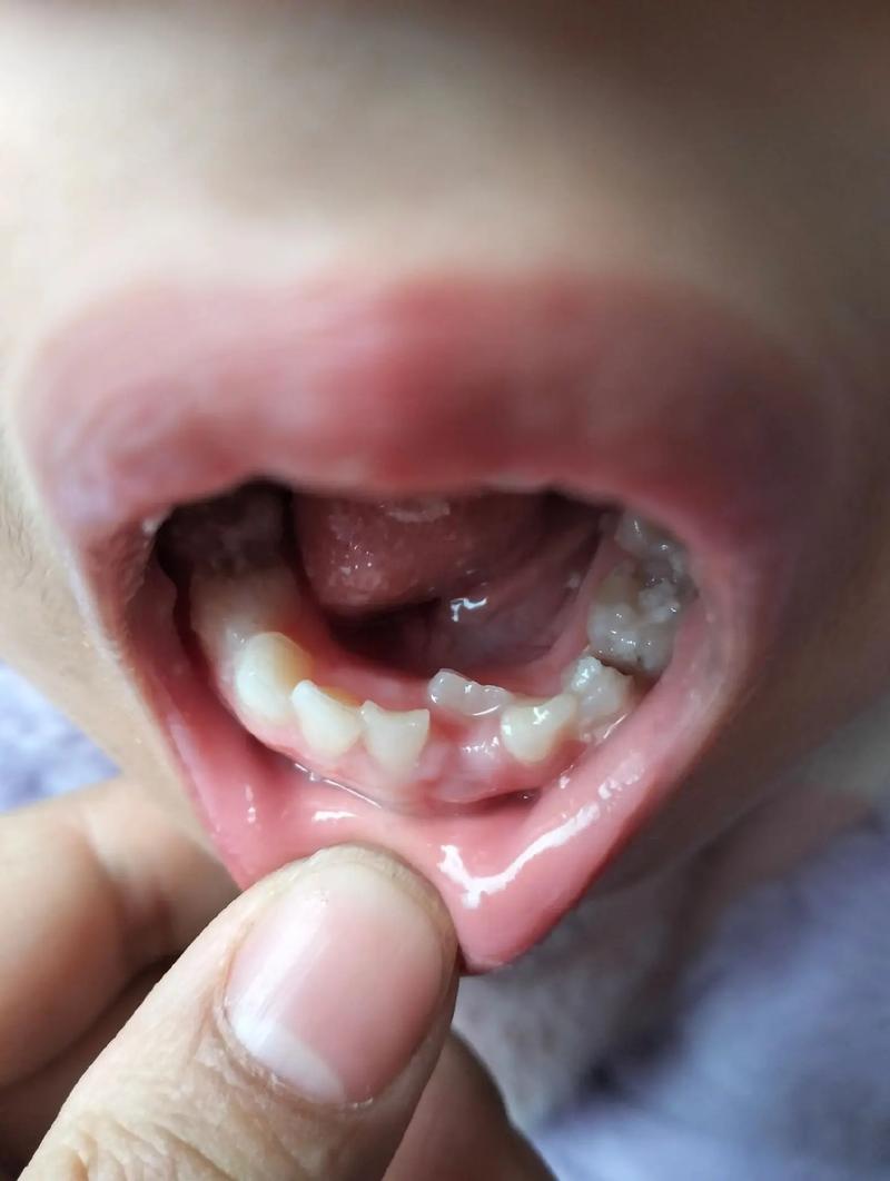 儿童牙龈上长牙齿是正常现象吗？需要处理吗？-第2张图片-郑州医学网