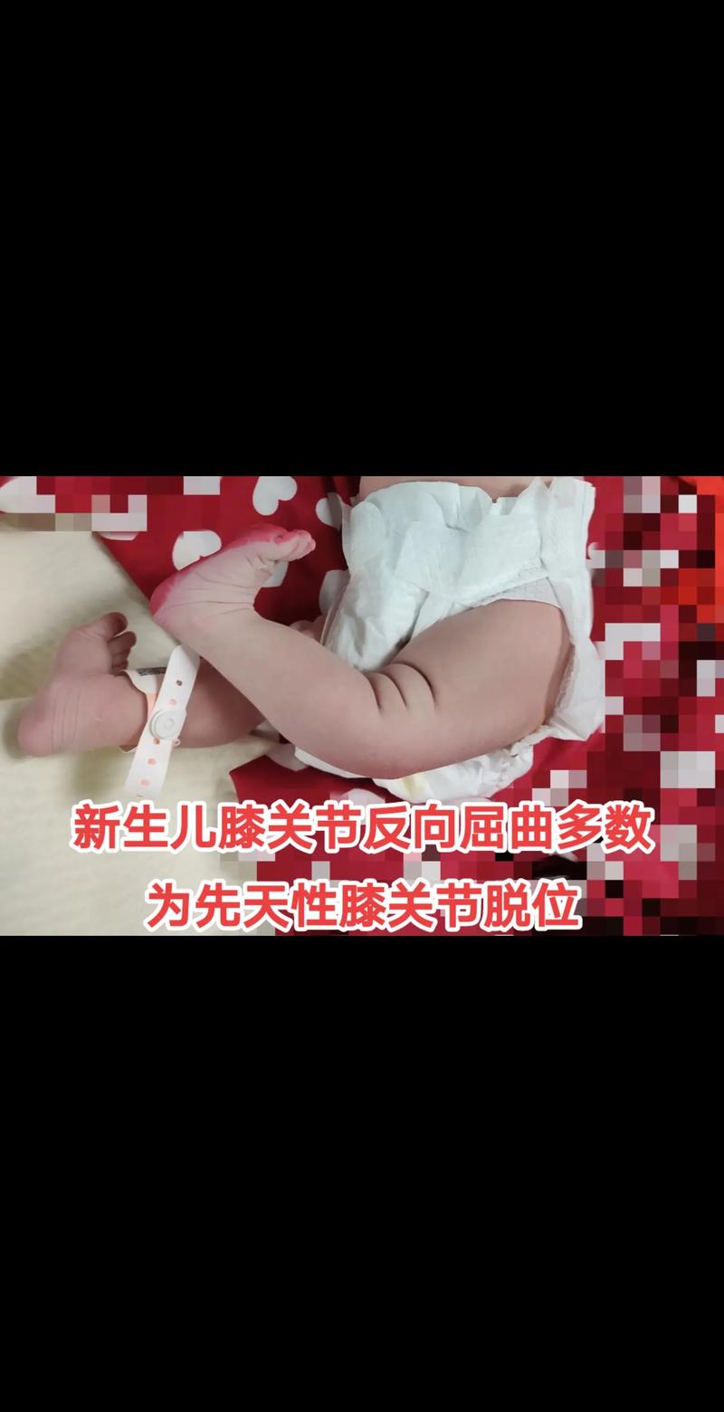 新生儿膝盖骨头响是正常发育现象还是骨骼异常信号？-第1张图片-郑州医学网