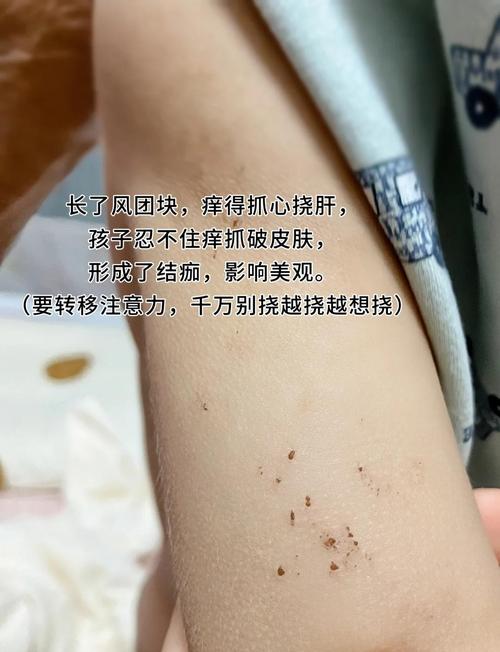 孩子身上莫名起包又痒，到底是什么原因导致的呢？-第1张图片-郑州医学网