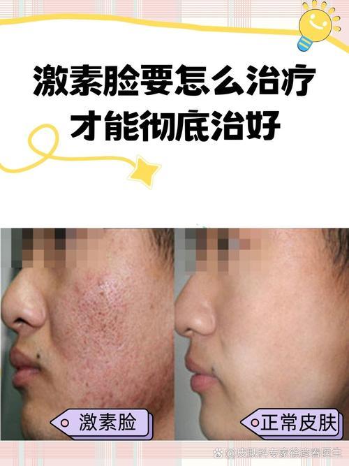 孕期激素脸反反复复,到底该怎么安全护理才能好?-第3张图片-郑州医学网 孕期激素脸反反复复,到底该怎么安全护理才能好?-第3张图片-郑州医学网