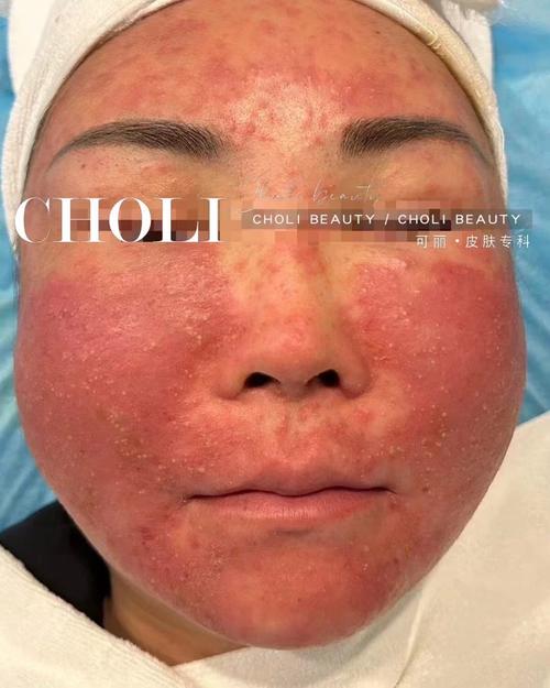 孕期激素脸反反复复,到底该怎么安全护理才能好?-第1张图片-郑州医学网 孕期激素脸反反复复,到底该怎么安全护理才能好?-第1张图片-郑州医学网