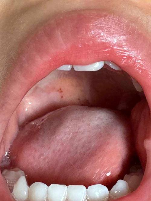 儿童扁桃体炎为何反复高烧？如何有效预防与科学护理？-第3张图片-郑州医学网