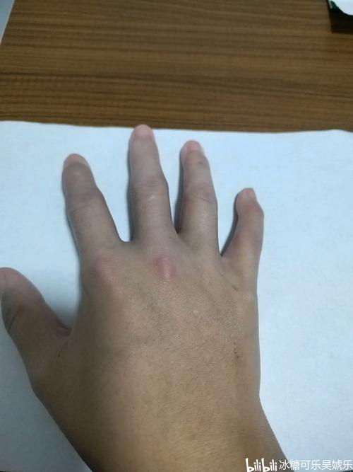 未分化结缔组织病孕期如何管理才能保障母婴安全?-第1张图片-郑州医学网 未分化结缔组织病孕期如何管理才能保障母婴安全?-第1张图片-郑州医学网