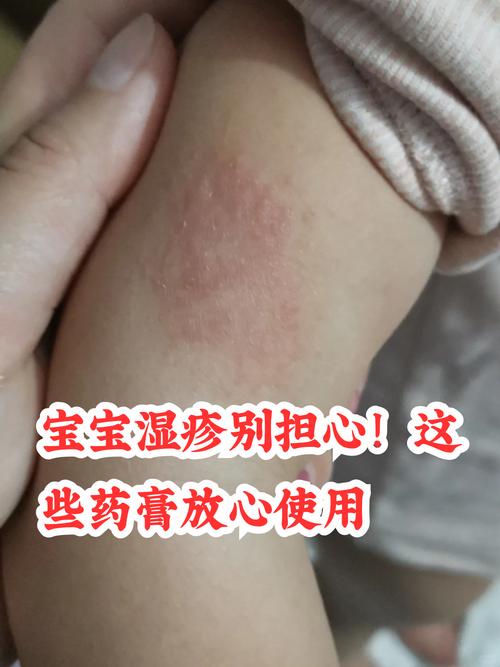 地奈德乳膏儿童使用安全吗？适用年龄与剂量该如何把控？-第1张图片-郑州医学网