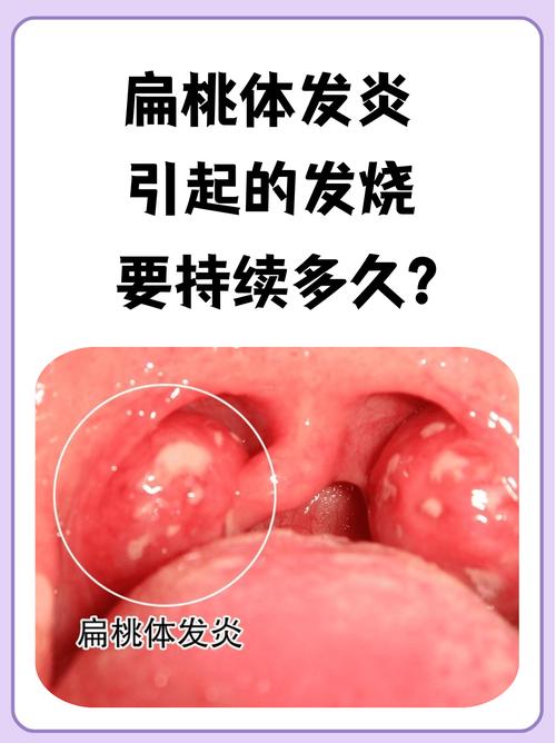 备孕期扁桃体发炎发烧会影响怀孕吗?需要用药治疗吗?-第1张图片-郑州医学网 备孕期扁桃体发炎发烧会影响怀孕吗?需要用药治疗吗?-第1张图片-郑州医学网