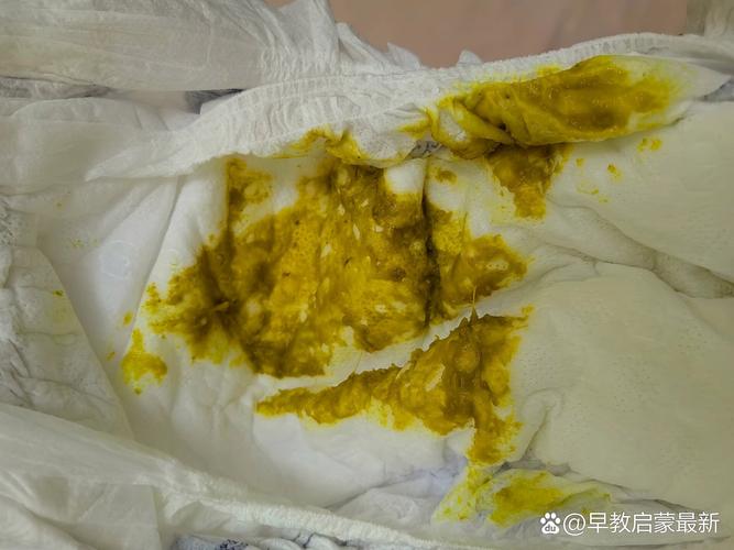 新生儿第一天没大便，是正常现象还是需要警惕的健康信号？-第1张图片-郑州医学网