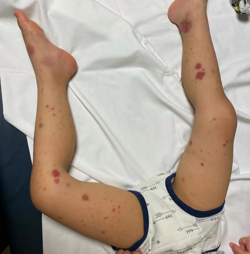 儿童过敏性紫癜图片长啥样？早期症状和皮疹特征有哪些？-第1张图片-郑州医学网