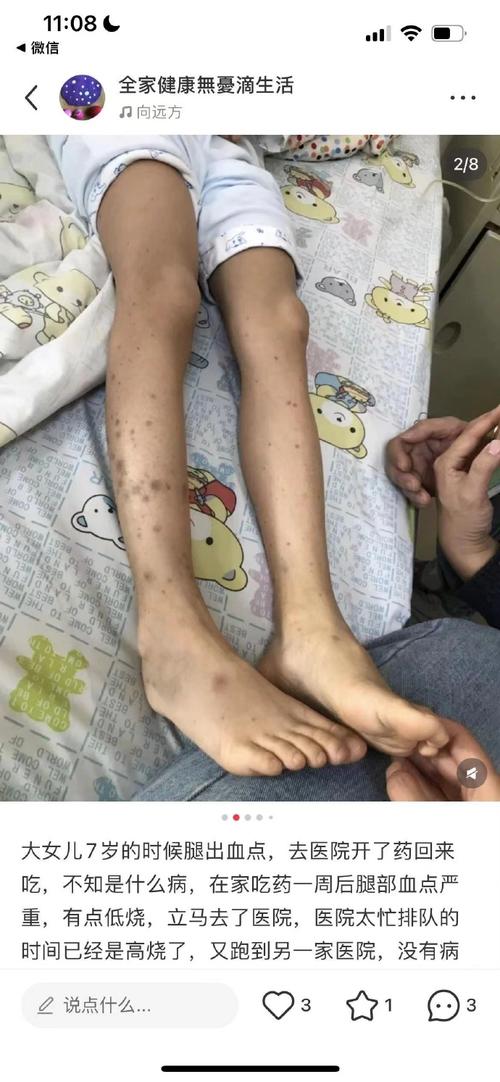 儿童过敏性紫癜图片长啥样？早期症状和皮疹特征有哪些？-第2张图片-郑州医学网