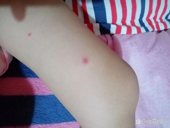 儿童过敏性紫癜图片长啥样？早期症状和皮疹特征有哪些？-第3张图片-郑州医学网