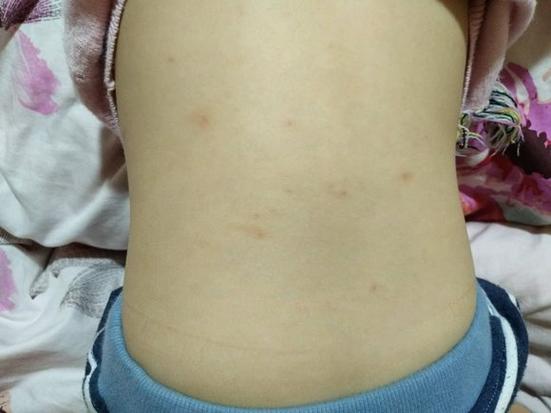 儿童身上起红疙瘩却不痒，是哪些原因导致的？-第2张图片-郑州医学网