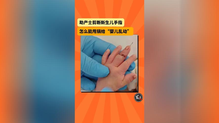 新生儿六个手指头是什么原因导致的？与遗传或孕期因素有关吗？-第3张图片-郑州医学网
