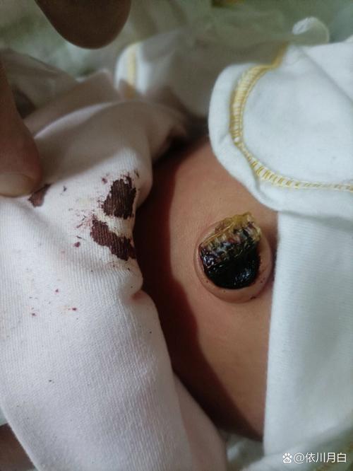 新生儿第七天肚脐出血正常吗？该如何护理和处理？-第2张图片-郑州医学网