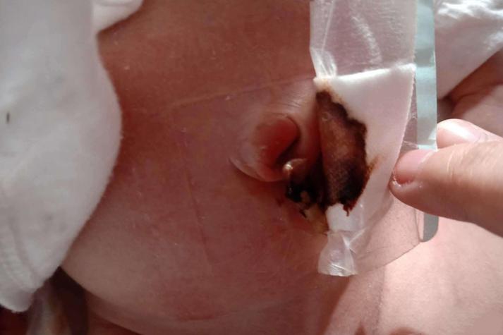 新生儿十几天肚脐出血是正常现象还是异常情况？该如何正确护理？-第3张图片-郑州医学网