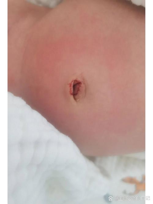 新生儿十几天肚脐出血是正常现象还是异常情况?该如何正确护理?-第1张图片-郑州医学网 新生儿十几天肚脐出血是正常现象还是异常情况?该如何正确护理?-第1张图片-郑州医学网