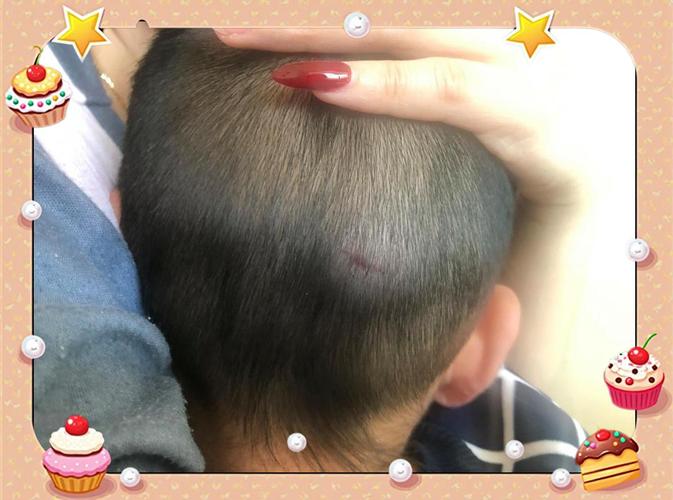 新生儿头顶被撞后，家长该如何判断伤情及正确处理？-第2张图片-郑州医学网