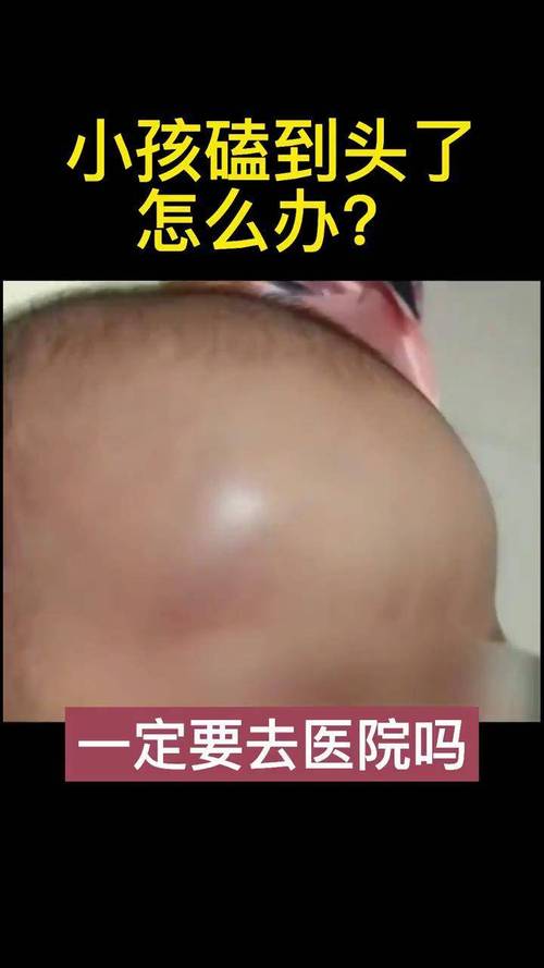 新生儿头顶被撞后，家长该如何判断伤情及正确处理？-第1张图片-郑州医学网