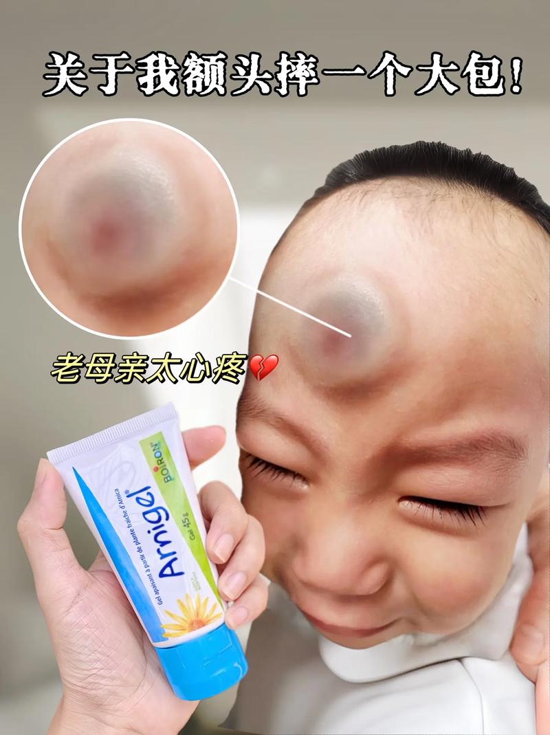 新生儿头顶被撞后，家长该如何判断伤情及正确处理？-第3张图片-郑州医学网