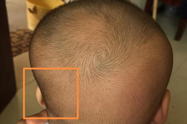 新生儿脑袋一侧出现凹陷是正常现象还是异常信号?需要警惕哪些潜在问题?-第1张图片-郑州医学网 新生儿脑袋一侧出现凹陷是正常现象还是异常信号?需要警惕哪些潜在问题?-第1张图片-郑州医学网