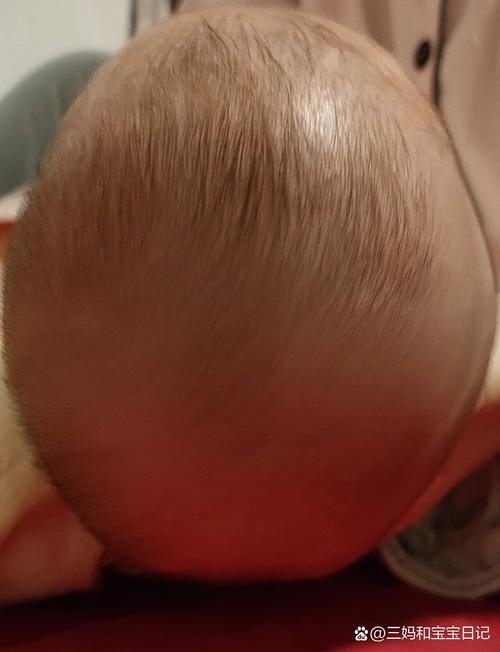 新生儿脑袋一侧出现凹陷是正常现象还是异常信号？需要警惕哪些潜在问题？-第3张图片-郑州医学网