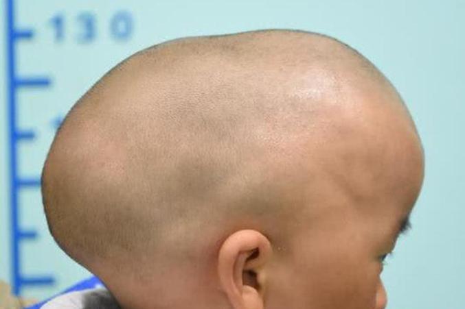 新生儿脑袋一侧出现凹陷是正常现象还是异常信号？需要警惕哪些潜在问题？-第2张图片-郑州医学网