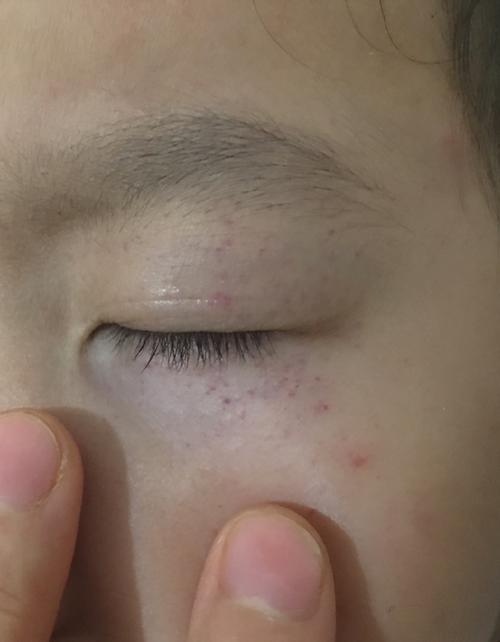 儿童发烧眼皮出现红点是何原因？需要警惕哪些疾病？-第1张图片-郑州医学网
