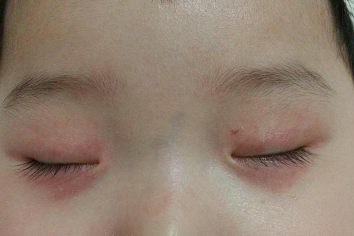 儿童发烧眼皮出现红点是何原因？需要警惕哪些疾病？-第2张图片-郑州医学网