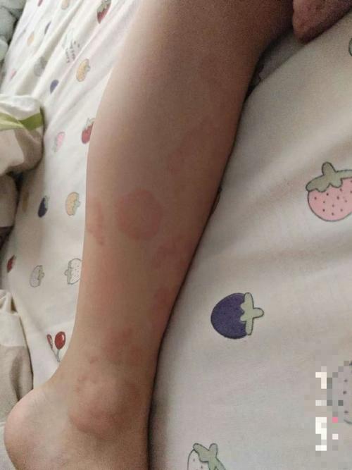 儿童荨麻疹是什么症状-第2张图片-郑州医学网 儿童荨麻疹是什么症状-第2张图片-郑州医学网