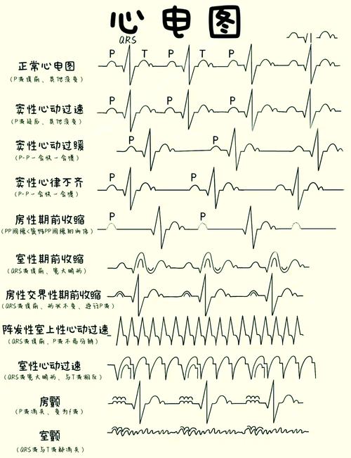 儿童心电图正常值范围会因年龄变化吗?不同年龄段儿童的心电图指标有何差异?-第2张图片-郑州医学网 儿童心电图正常值范围会因年龄变化吗?不同年龄段儿童的心电图指标有何差异?-第2张图片-郑州医学网