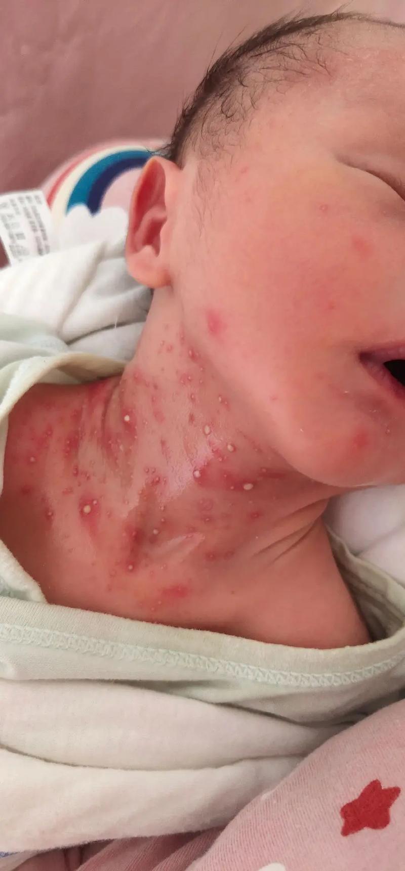 新生儿盐泡的具体形态和形成过程是怎样的？会对婴儿皮肤产生哪些影响？-第2张图片-郑州医学网