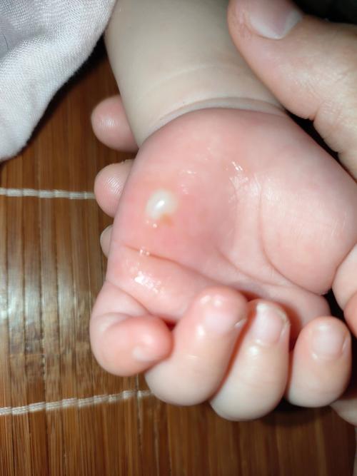 新生儿盐泡的具体形态和形成过程是怎样的？会对婴儿皮肤产生哪些影响？-第1张图片-郑州医学网