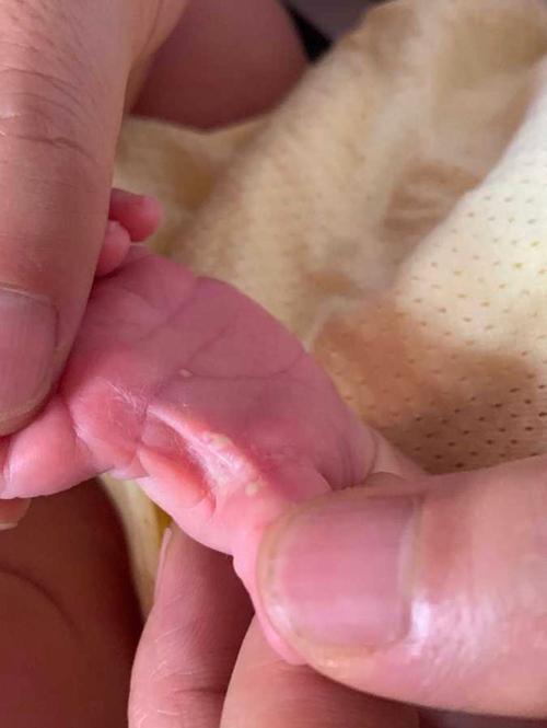 新生儿盐泡的具体形态和形成过程是怎样的？会对婴儿皮肤产生哪些影响？-第3张图片-郑州医学网