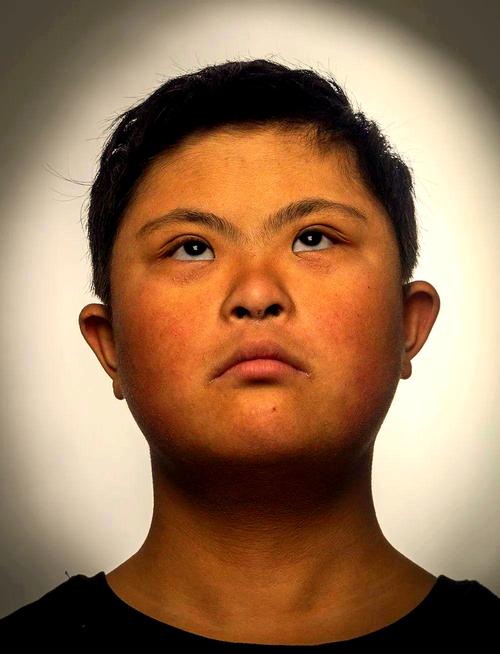 唐氏综合征新生儿有哪些典型表现？如何早期识别与干预？-第1张图片-郑州医学网