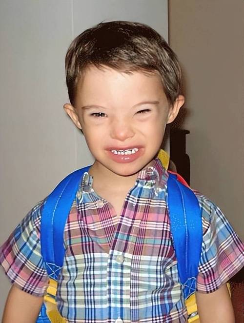 唐氏综合征新生儿有哪些典型表现？如何早期识别与干预？-第3张图片-郑州医学网