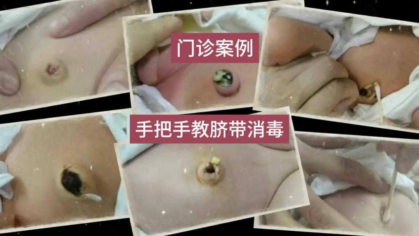 新生儿肚脐有血是正常现象吗?需要立即处理还是观察等待?-第2张图片-郑州医学网 新生儿肚脐有血是正常现象吗?需要立即处理还是观察等待?-第2张图片-郑州医学网