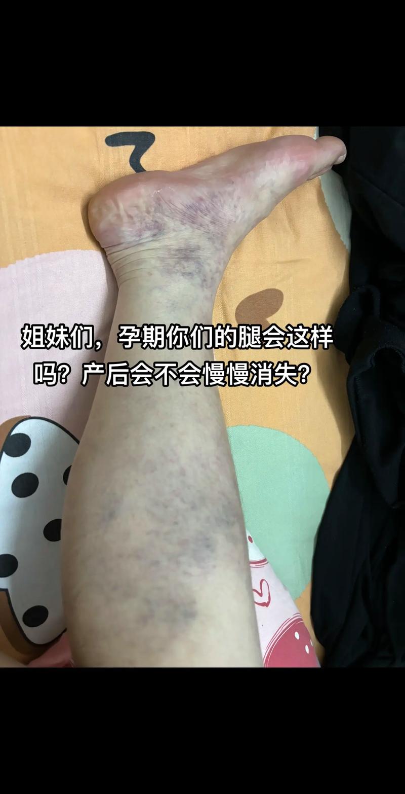 怀孕期间血管鼓起来了-第1张图片-郑州医学网