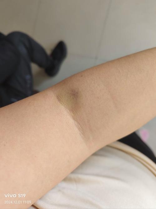 怀孕期间血管鼓起来了-第3张图片-郑州医学网