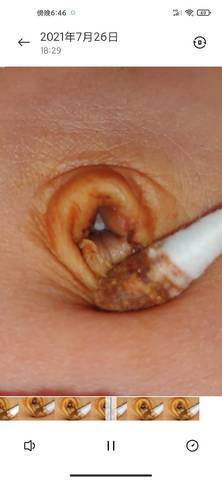 新生儿脐茸治疗前后对比图片效果如何？护理时要注意哪些事项？-第1张图片-郑州医学网