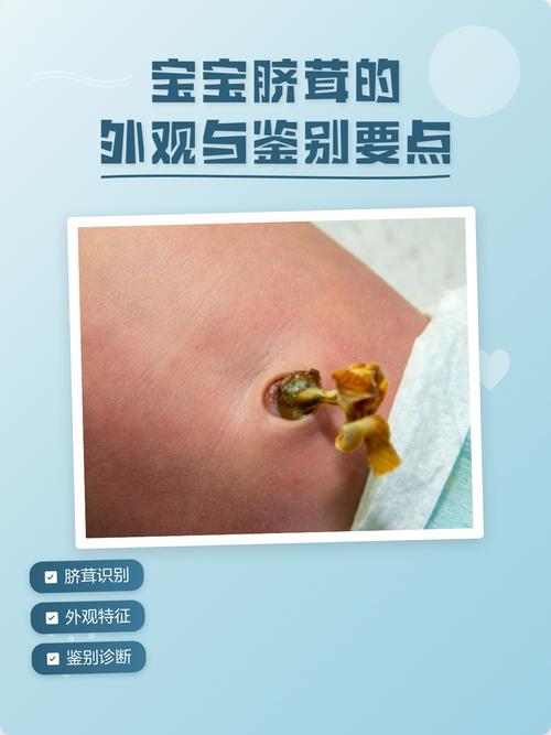 新生儿脐茸治疗前后对比图片效果如何？护理时要注意哪些事项？-第2张图片-郑州医学网