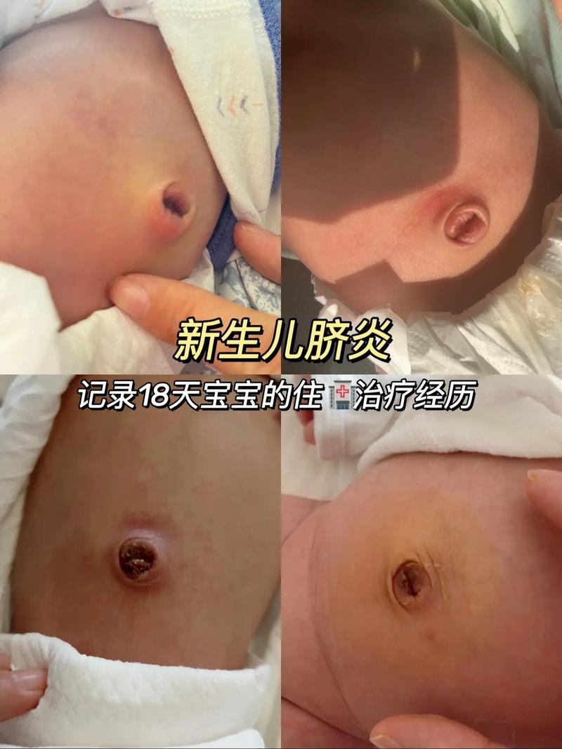 新生儿脐茸治疗前后对比图片效果如何？护理时要注意哪些事项？-第3张图片-郑州医学网