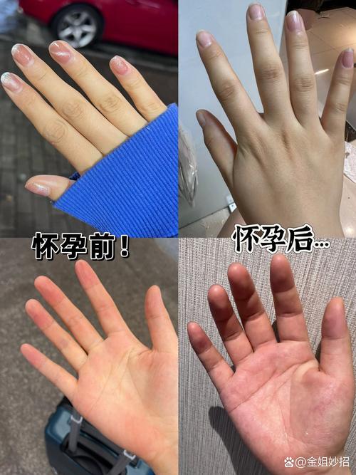 怀孕期间手肿是正常现象吗？需要警惕哪些潜在问题？-第1张图片-郑州医学网