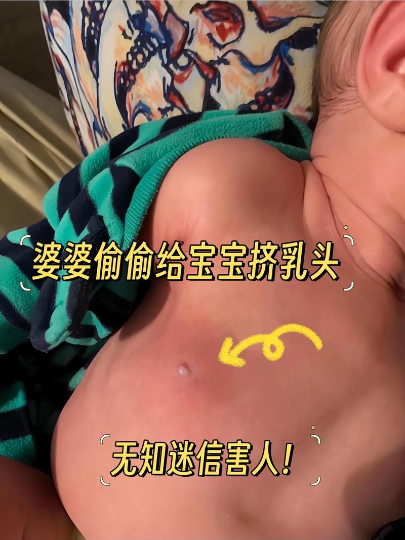 新生儿乳头需要挤吗？这种做法科学吗？对宝宝健康有影响吗？-第2张图片-郑州医学网