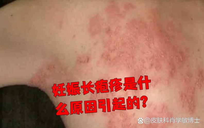 怀孕期间疱疹反复发作，会对胎儿造成哪些不良影响？-第3张图片-郑州医学网