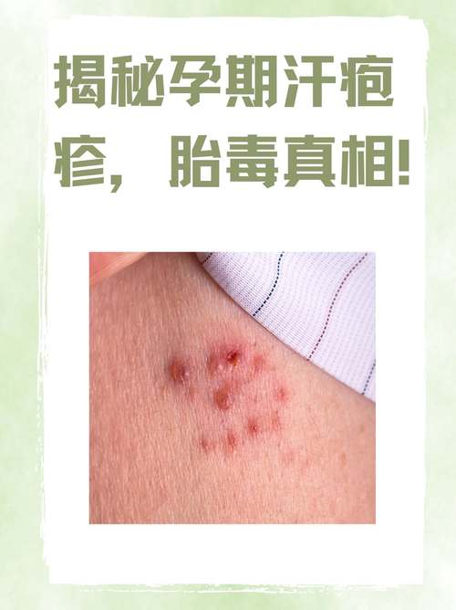 怀孕期间疱疹反复发作，会对胎儿造成哪些不良影响？-第2张图片-郑州医学网