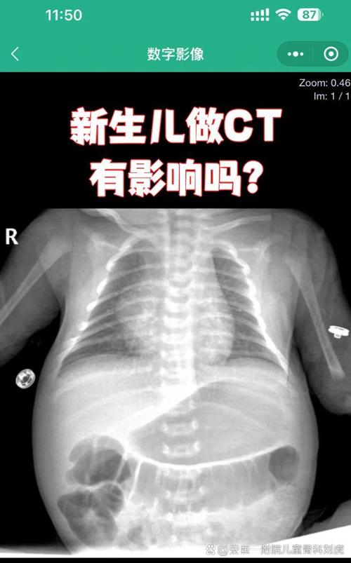 新生儿做CT检查到底有没有影响？辐射风险与发育安全该如何权衡？-第2张图片-郑州医学网