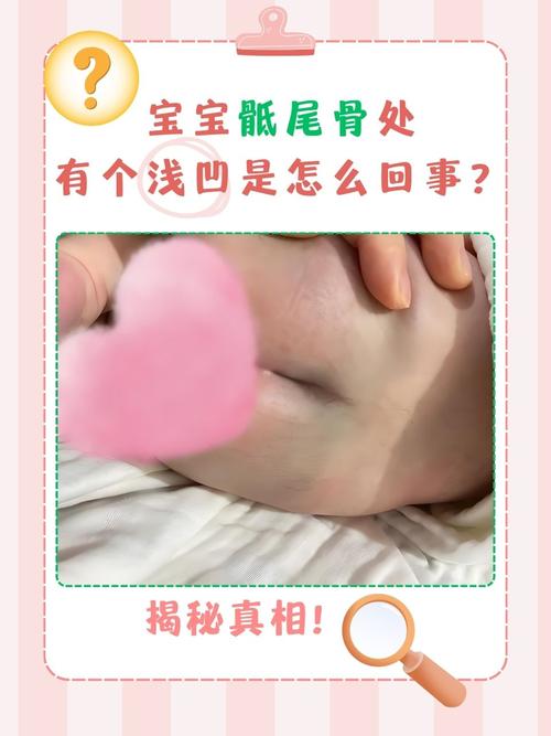 新生儿尾骨处有个小洞是先天畸形吗？需要治疗吗？-第1张图片-郑州医学网