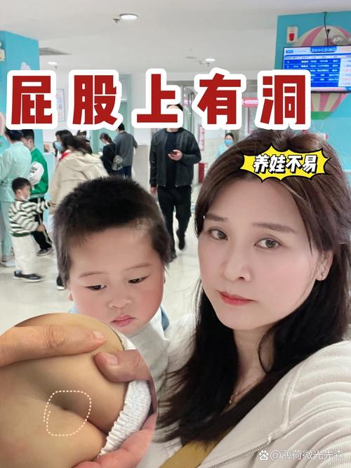 新生儿尾骨处有个小洞是先天畸形吗？需要治疗吗？-第3张图片-郑州医学网